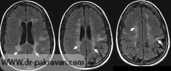 پلاکهای سفید در MRI بیمار مبتلا به MS